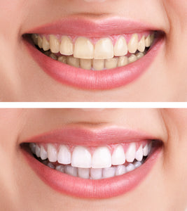 Megastar Smile Deluxe Zahnaufhellung -  2 x 65 Minuten (Jetzt 10% Sparen)